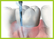 VECTOR terápia. A fogkő eltávolításának legkorszerűbb és legkíméletesebb módja.